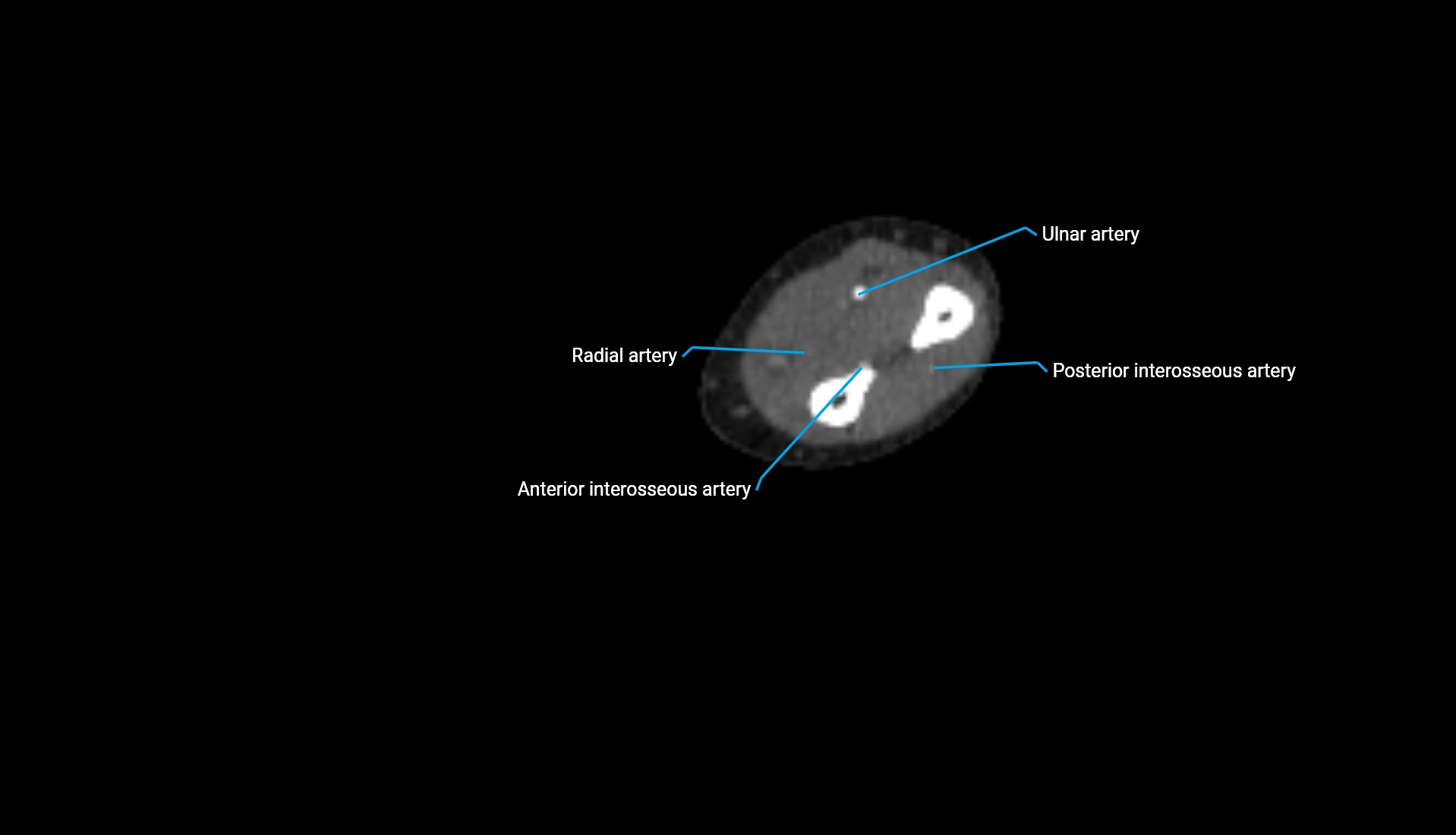 CTA upper limb axial cross sectional anatomy labelled image 142 (2).webp